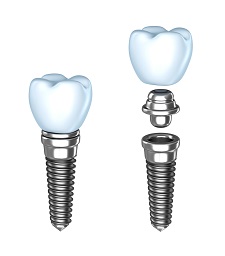 Dental Implants | Dentist in Greensboro, NC | Norman & Gill Dentistry